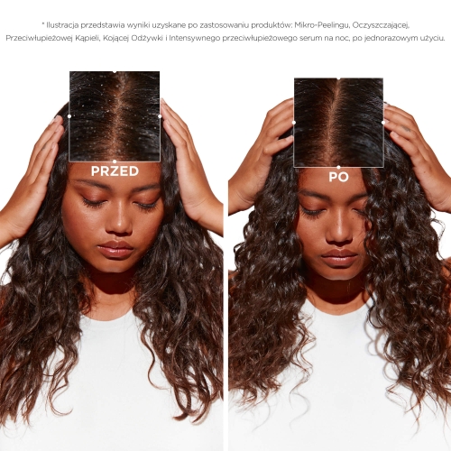 Efekty stosowania Symbiose – zdjęcie przed i po kuracji przeciwłupieżowej