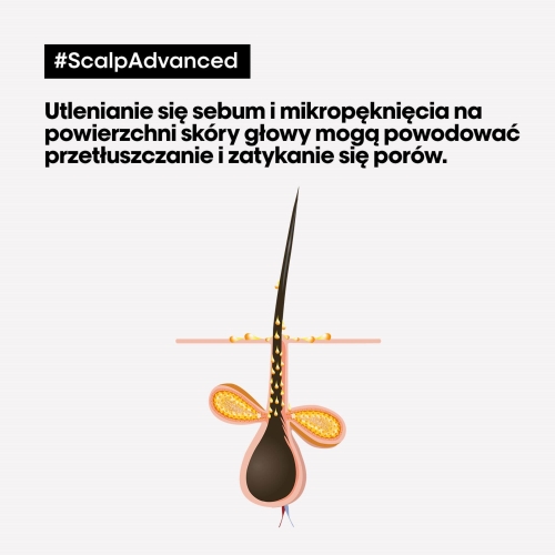 Ilustracja skóry głowy z widocznym nadmiarem sebum przy mieszku włosowym.