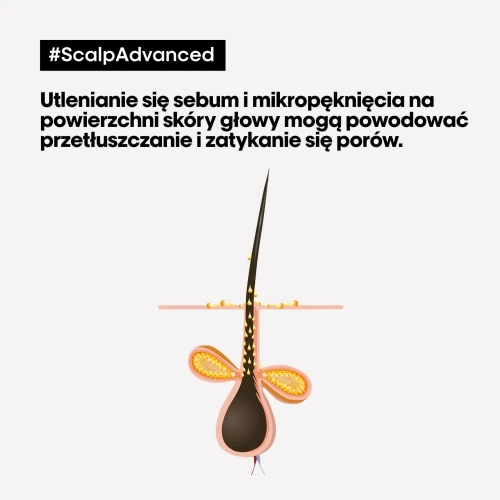 Schemat mieszka włosowego z zaznaczonym nadmiarem sebum i zatykaniem porów.